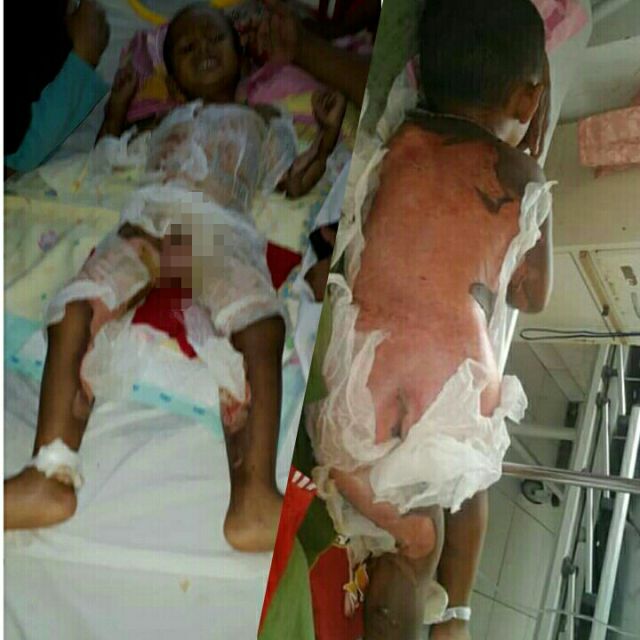 Terendam Air Panas, 90 Persen Tubuh Anak ini Melepuh
