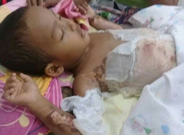 Bocah Tercebur Air Panas Akhirnya Meninggal