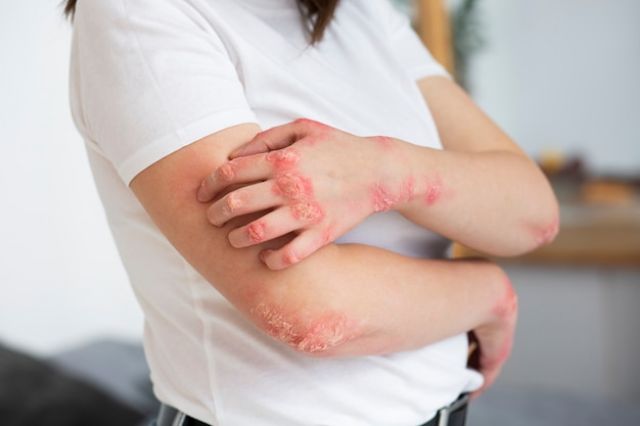 Kenali Jenis-jenis Dermatitis dan Penyebabnya